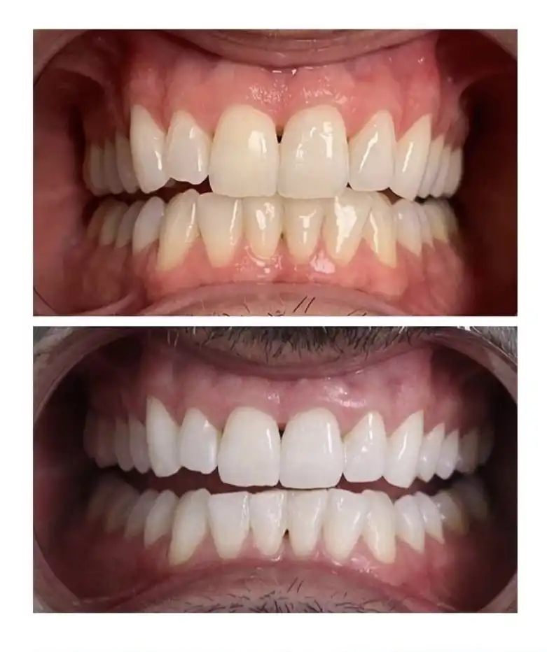 microblading,brows,tattoo removal